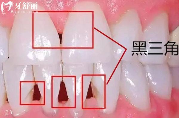 牙齒黑三角的危害有多大