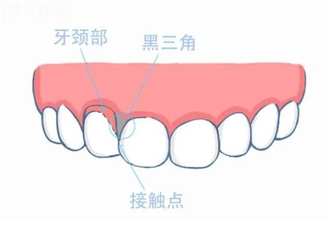 牙齒黑三角怎么補(bǔ)救