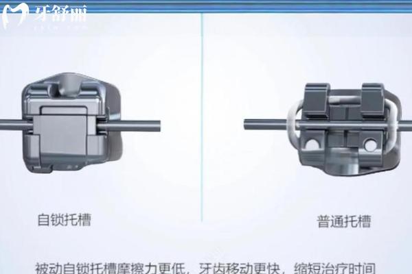 牙套多少錢價(jià)格表2024