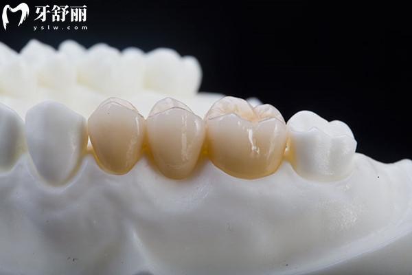 活動假牙的種類及價(jià)格詳細(xì)介紹