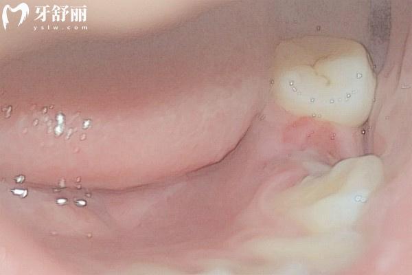 拔牙后窟窿要多久能長平
