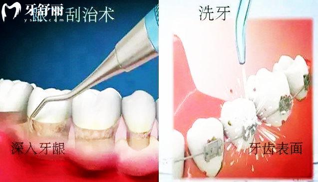 洗牙和牙周刮治的區(qū)別