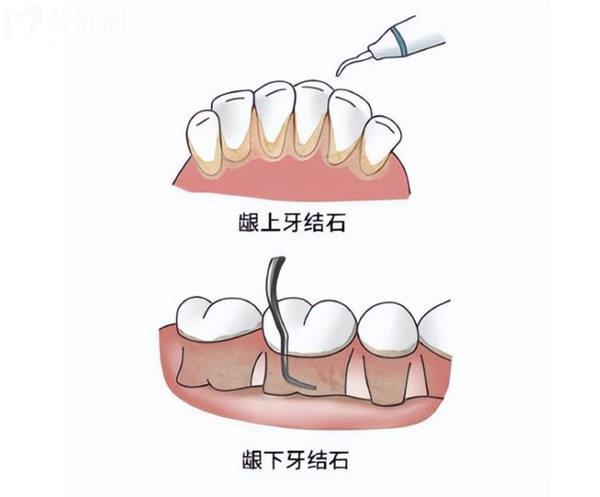 牙周刮治