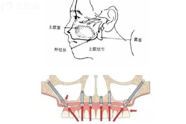 缺牙多年牙槽骨吸收還能種牙嗎