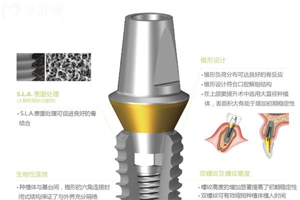 韓國(guó)登騰種植牙使用壽命是多少時(shí)間