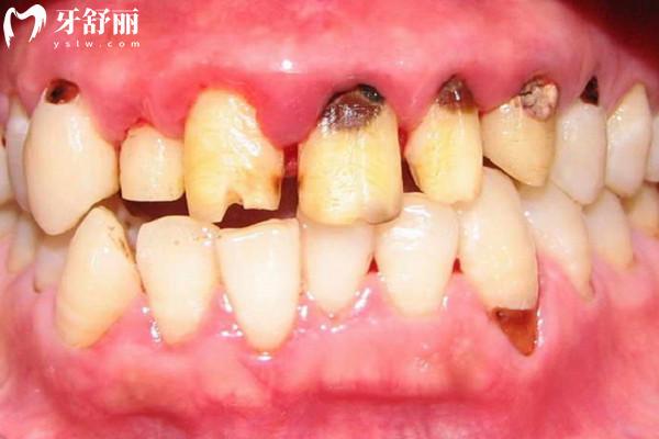 牙周病如何治療療效好