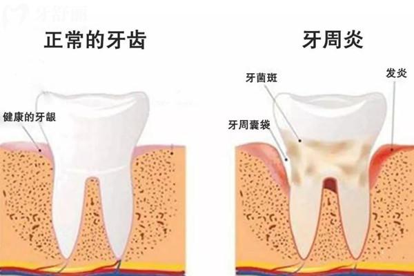 牙周病如何治療療效好