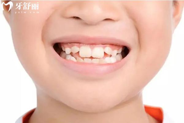 8歲孩子門牙外凸怎么矯正