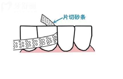 正畸片切