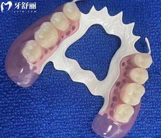 假牙hpp支架和維他靈支架哪個好