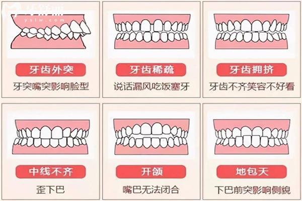 牙齒畸形類型