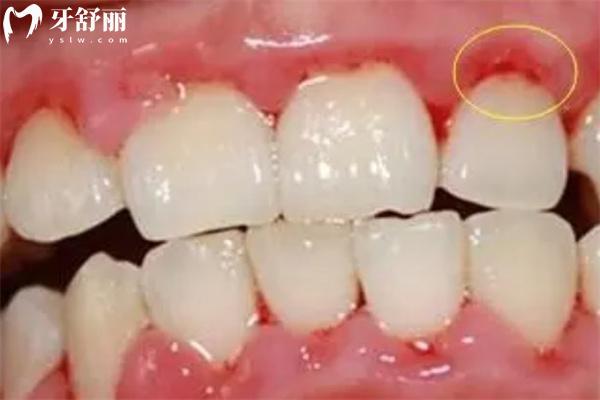 牙周袋長(zhǎng)什么樣子圖片