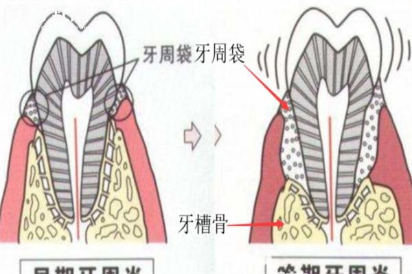 牙周袋長(zhǎng)什么樣子圖片