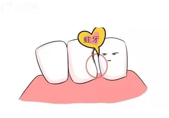 鄰面齲齒的治療方法有哪些