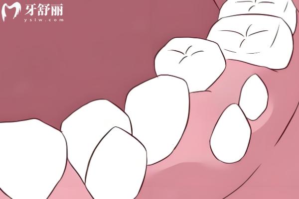 成人多生牙拔除有什么風(fēng)險嗎？