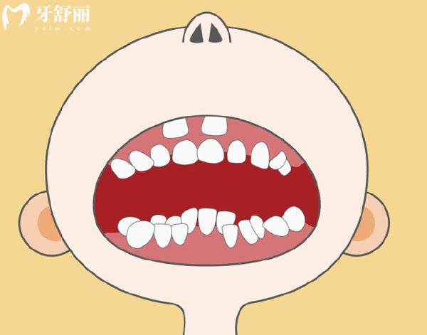 雙排牙形成的原因有哪些
