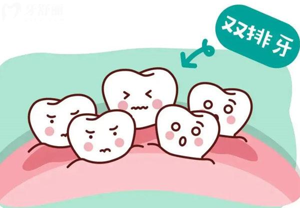 兒童雙排牙的治療方法有哪些