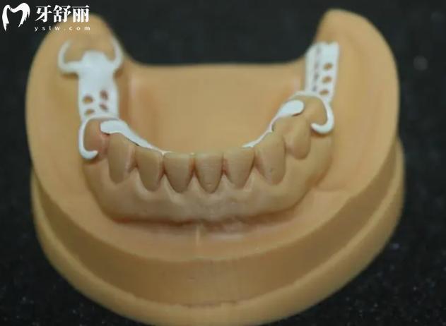 peek活動(dòng)義齒支架的優(yōu)點(diǎn)和缺點(diǎn)