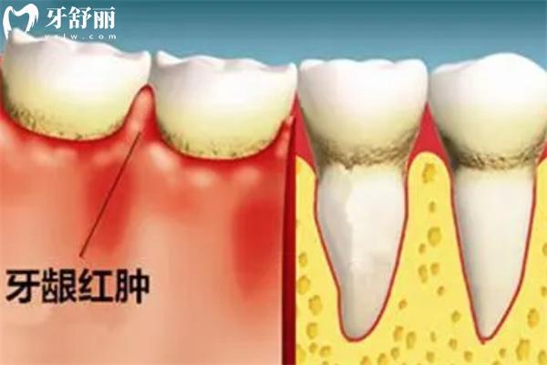 牙周炎圖片及癥狀圖片大全