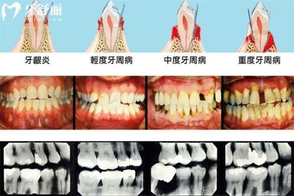牙周炎圖片及癥狀圖片大全