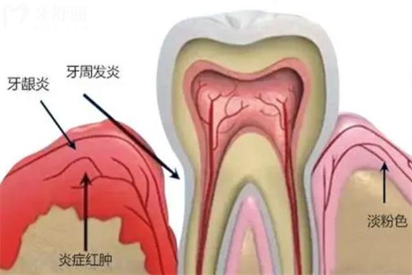 牙周炎圖片及癥狀圖片大全