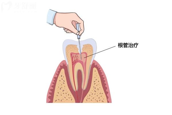 牙神經(jīng)為什么會外露？癥狀＋治療＋預(yù)防一文了解