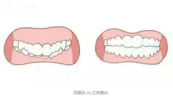 深覆合圖片和正常牙齒圖片:告訴你為什么必選要矯正