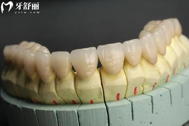 烤瓷牙崩瓷露出金屬如何修復(fù)