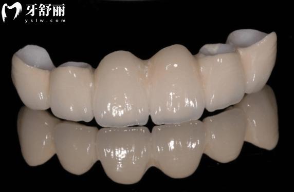 烤瓷牙崩瓷露出金屬如何修復(fù)