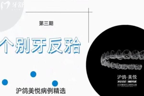 滬鴿美悅隱形矯正怎樣呢？