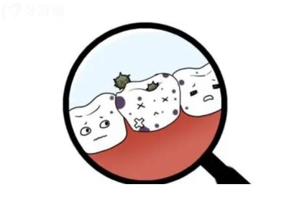 黃色牙垢的堆積才是蛀牙、爛牙的元兇！快來看看