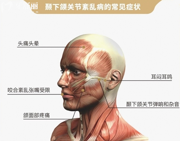 顳下頜關(guān)節(jié)炎早期癥狀