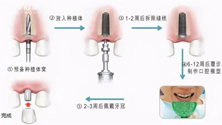 韓國種植牙什么品牌質(zhì)量出名