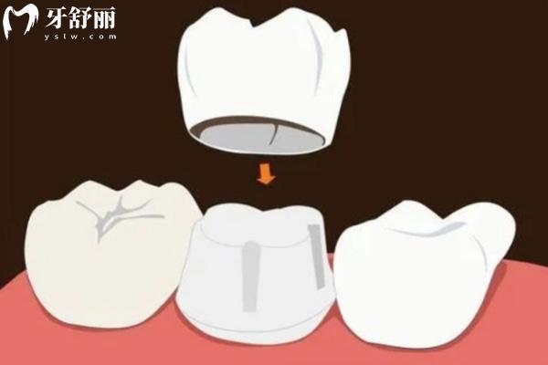 牙齒掉了一塊補(bǔ)牙還是鑲牙好