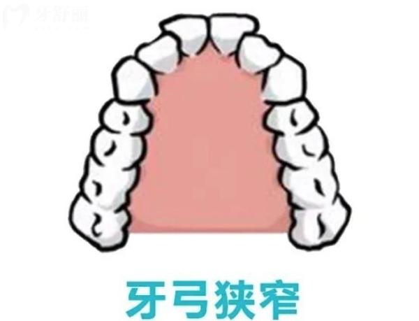 兒童牙弓狹窄需要干預(yù)嗎