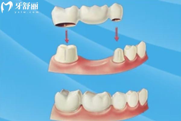 鑲牙與種牙有什么區(qū)別？