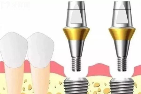 種植牙基臺是什么材料做的