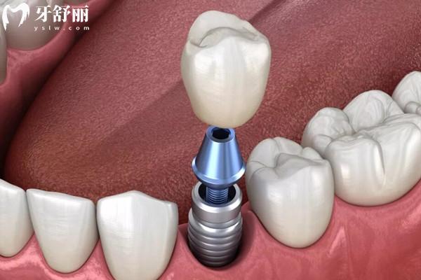 種植牙基臺是什么材料做的