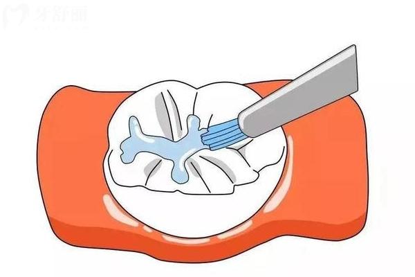 什么是窩溝封閉？拿好保護(hù)兒牙的武器，避免齲齒的發(fā)生