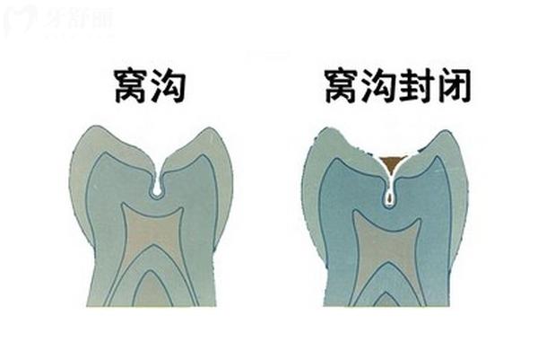 什么是窩溝封閉？拿好保護(hù)兒牙的武器，避免齲齒的發(fā)生