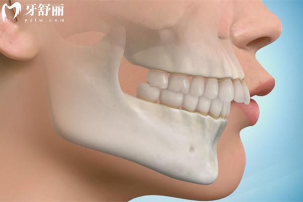 怎么區(qū)分骨性齙牙和牙性齙牙