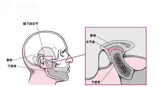 顳下頜關(guān)節(jié)紊亂能正畸嗎？深度解析矯正與顳下頜關(guān)節(jié)的關(guān)系