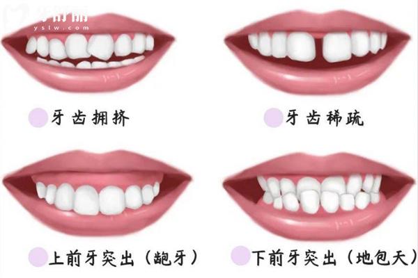 35歲整牙的真實(shí)感受