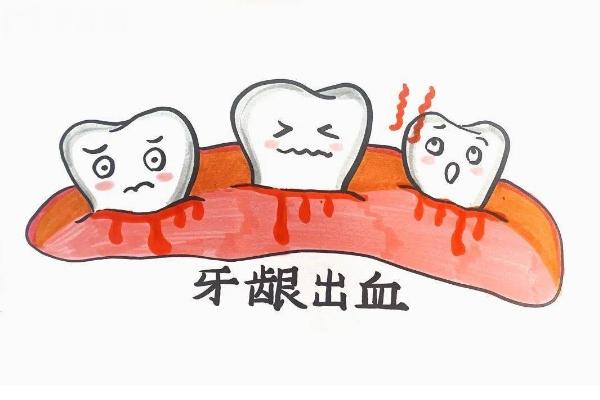 為什么刷牙總是出血？詳細介紹原因+預(yù)防+治療