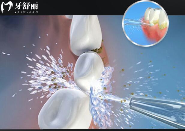 解析沖牙器：快速升級(jí)你的口腔護(hù)理知識(shí)