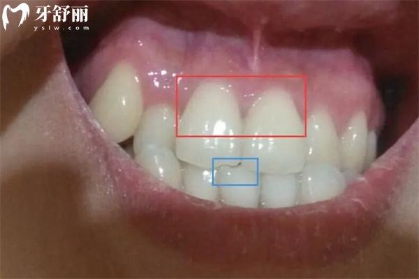 牙劈了怎么治療