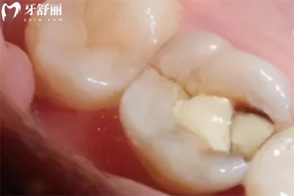 牙劈了怎么治療
