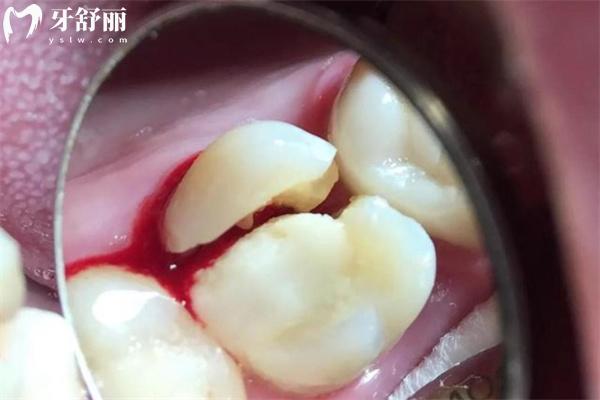 牙劈了怎么治療