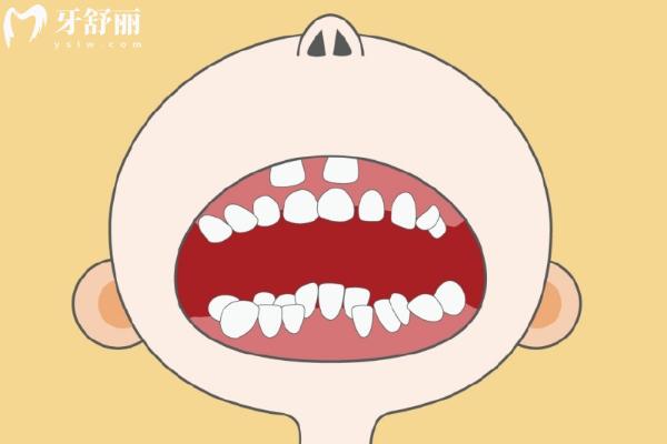 為什么孩子替牙期會出現雙排牙？掌握方法及時應對即可