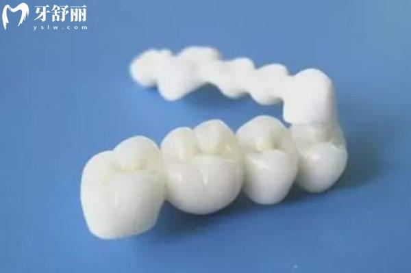 為什么更推薦全瓷牙冠